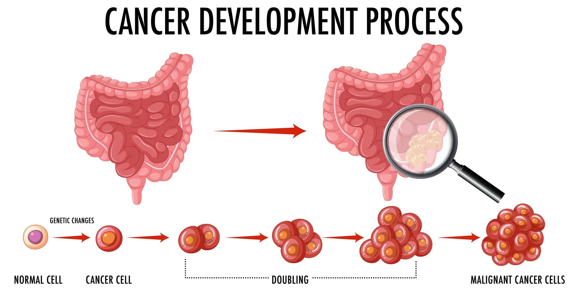 Ilustrasi proses terjadinya kanker usus besar (Sumber gambar : Freepik/brgfx)
