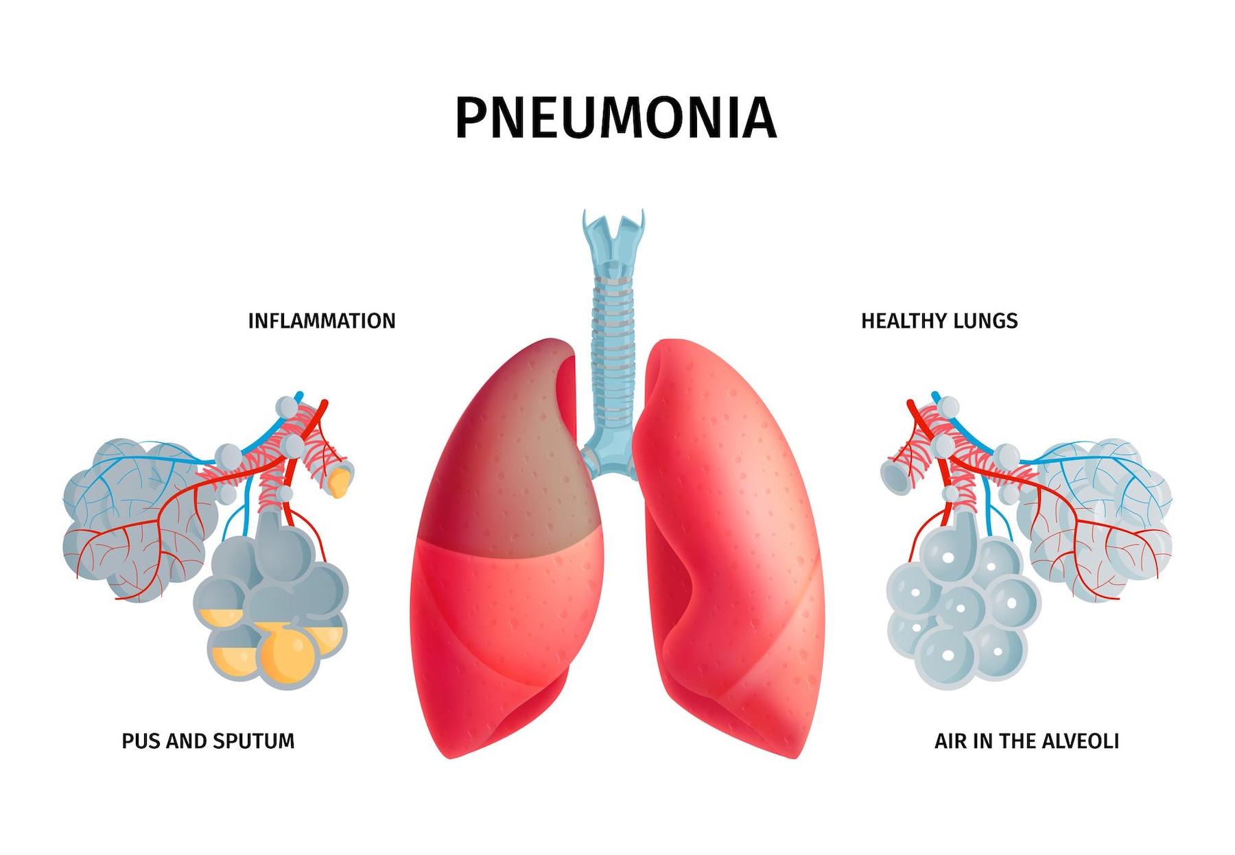 Ilustrasi kondisi pneumonia pada paru-paru. (Sumber gambar : Freepik/Macrovector)