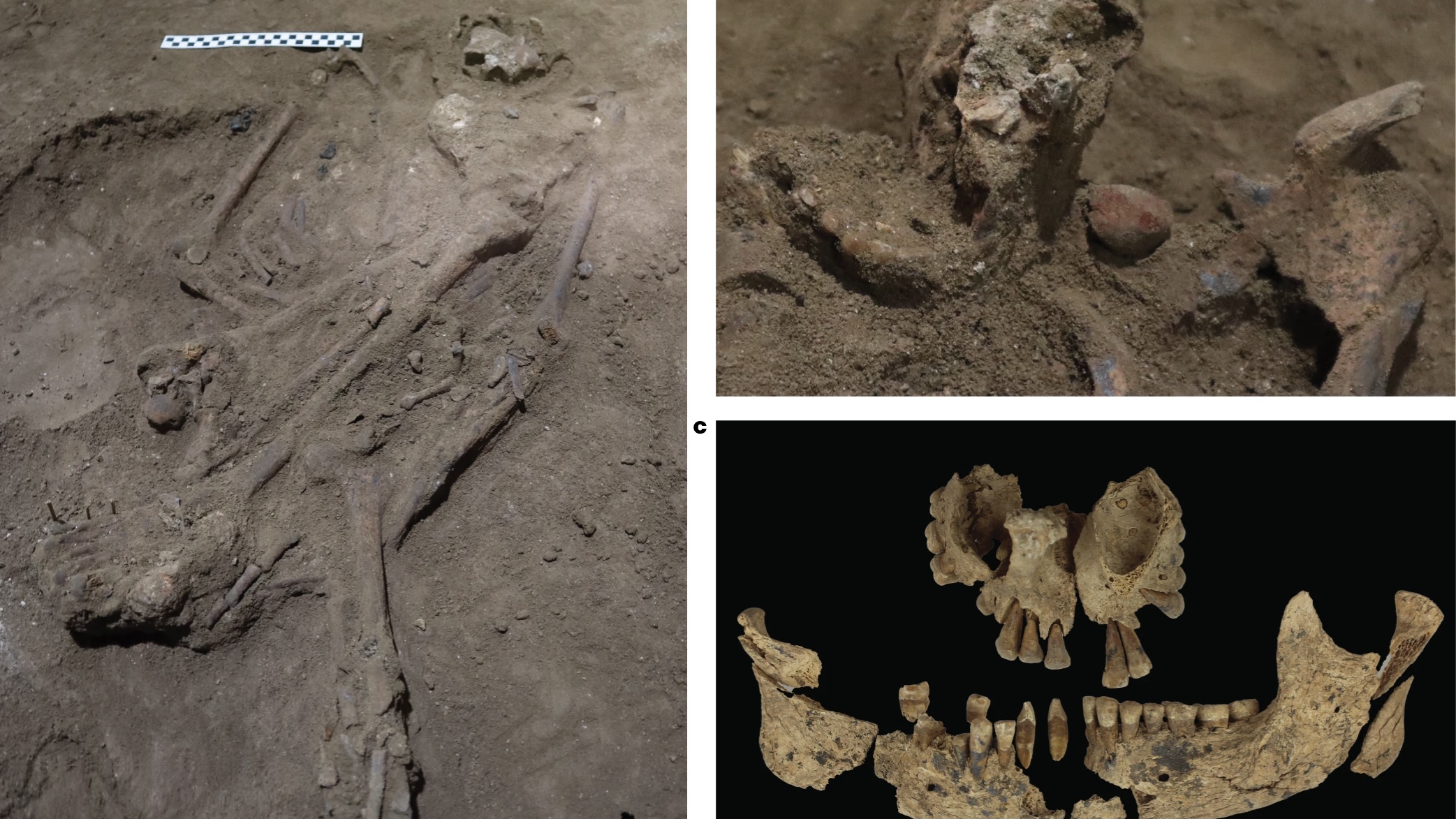 Fosil berusia 31.000 tahun yang menjalani operasi kaki. (Sumber gambar : Jurnal Nature/Tim Maloney)