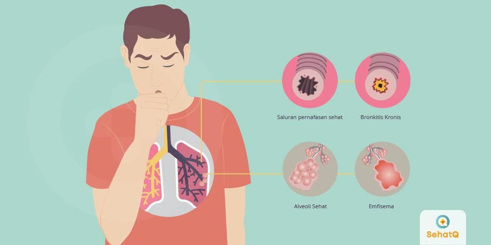 Ilustrasi penyakit paru paru/Kemenkes