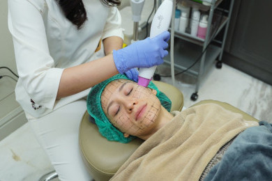 Mengenal Ulthermage, Teknologi Perawatan Lifting Tanpa Operasi