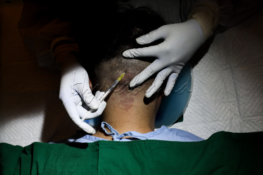 Bagi siapapun yang berminat merasakan transplantasi rambut harus menyiapkan kocek yang tidak sedikit. Biaya operasi ini mencapai puluhan juta, tergantung dari jumlah rambut yang akan ditanamkan.